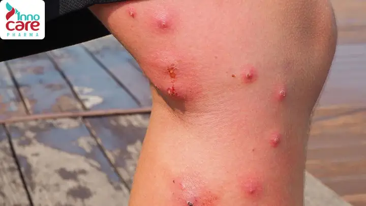 Bé Bị Muỗi Cắn Sưng Đỏ: Cách Xử Lý Nhanh Chóng Tại Nhà & Khi Nào Cần Gặp Bác Sĩ