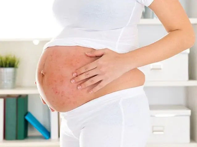 Bị Dị Ứng Khi Mang Thai: Nguyên Nhân, Biểu Hiện Và Cách Xử Lý An Toàn Cho Mẹ Bầu Bị Dị Ứng Khi Mang Thai: Nguyên Nhân, Biểu Hiện Và Cách Xử Lý An Toàn Cho Mẹ Bầu