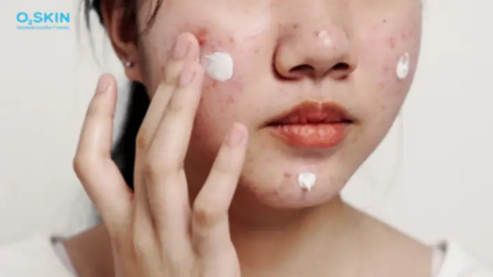 Nên Bôi Kem Trị Mụn Trước Hay Sau Kem Chống Nắng Để Đạt Hiệu Quả Tốt Nhất?