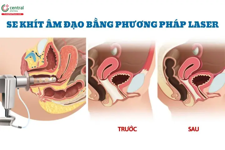 9+ Cách Làm Hồng Và Se Khít Vùng Kín An Toàn, Hiệu Quả Tại Nhà