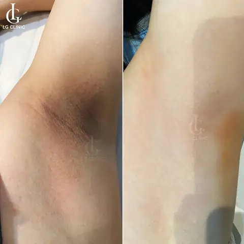 Cách Trị Thâm Nách Và Triệt Lông Hiệu Quả: Giải Pháp Toàn Diện Cho Vùng Da Sáng Mịn