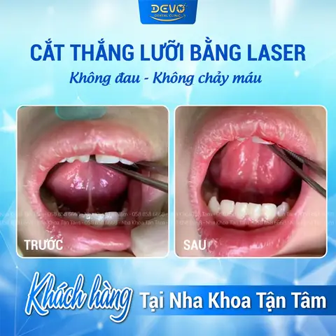 Cắt Thắng Lưỡi Cho Bé Bao Nhiêu Tiền? Chi Phí & Kinh Nghiệm Cần Biết
