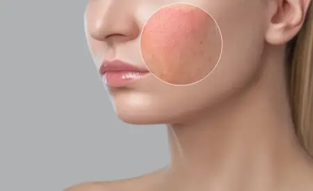 Dị Ứng Sữa Rửa Mặt Phải Làm Sao? Dấu Hiệu, Cách Xử Lý & Phòng Ngừa Hiệu Quả