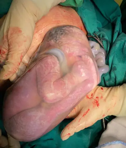 Em Bé Sinh Ra Còn Nguyên Trong Bọc: Giải Mã Hiện Tượng “đẻ Bọc Điều” Và Ý Nghĩa Phong Thủy