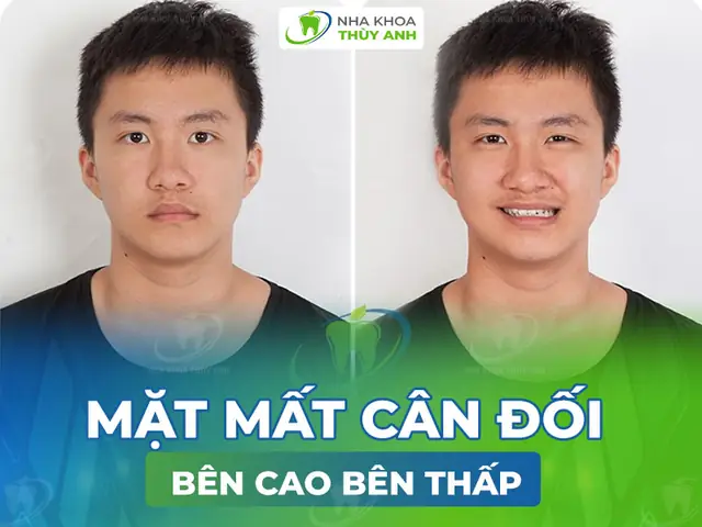 Mặt Bị Chảy Xệ Một Bên: Nguyên Nhân, Dấu Hiệu Và Cách Khắc Phục Hiệu Quả