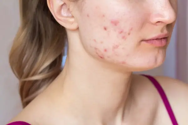 Mặt Nạ Giấy Trị Thâm Mụn Nhanh Nhất: Chọn Loại Nào Hiệu Quả?
