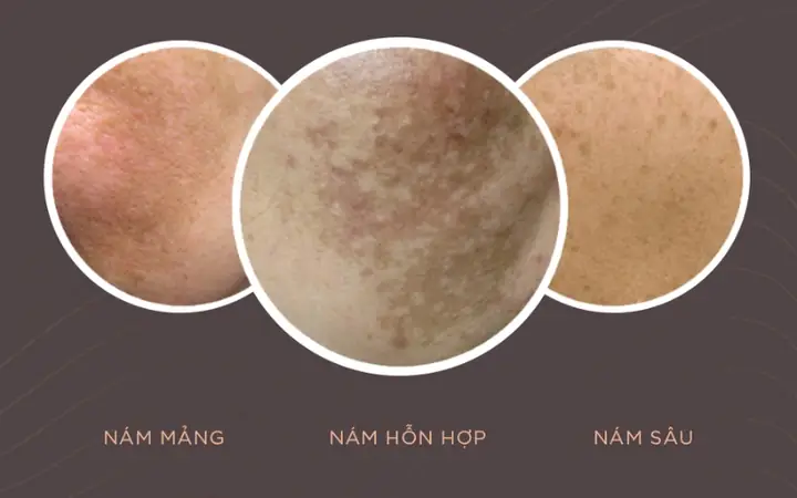 Mặt Nạ Trị Nám Không Bắt Nắng: Hướng Dẫn Chọn Lựa & Cách Dùng An Toàn