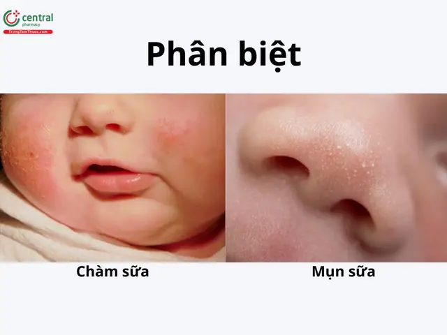 Trẻ Bị Chàm Sữa Bôi Gì? Top Kem & Cách Chăm Sóc Hiệu Quả